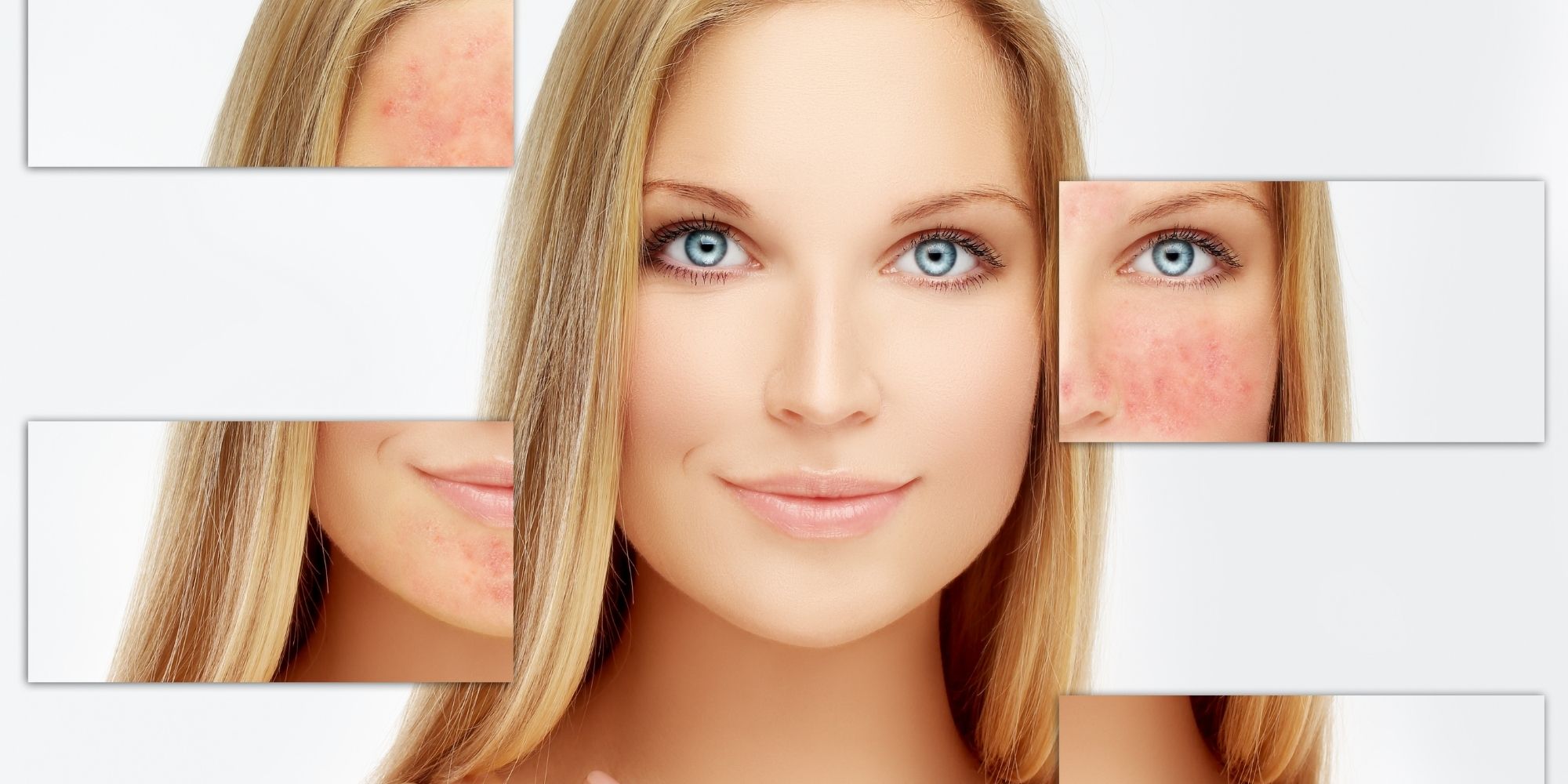 Do you have Rosacea or just Red Cheeks?