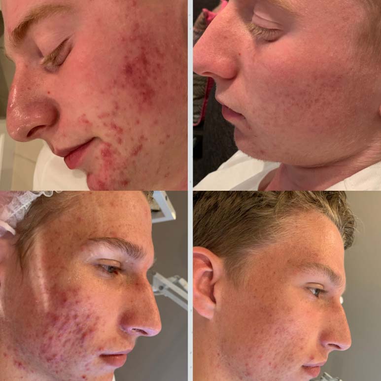 Blog Post: How to get rid of teen acne?